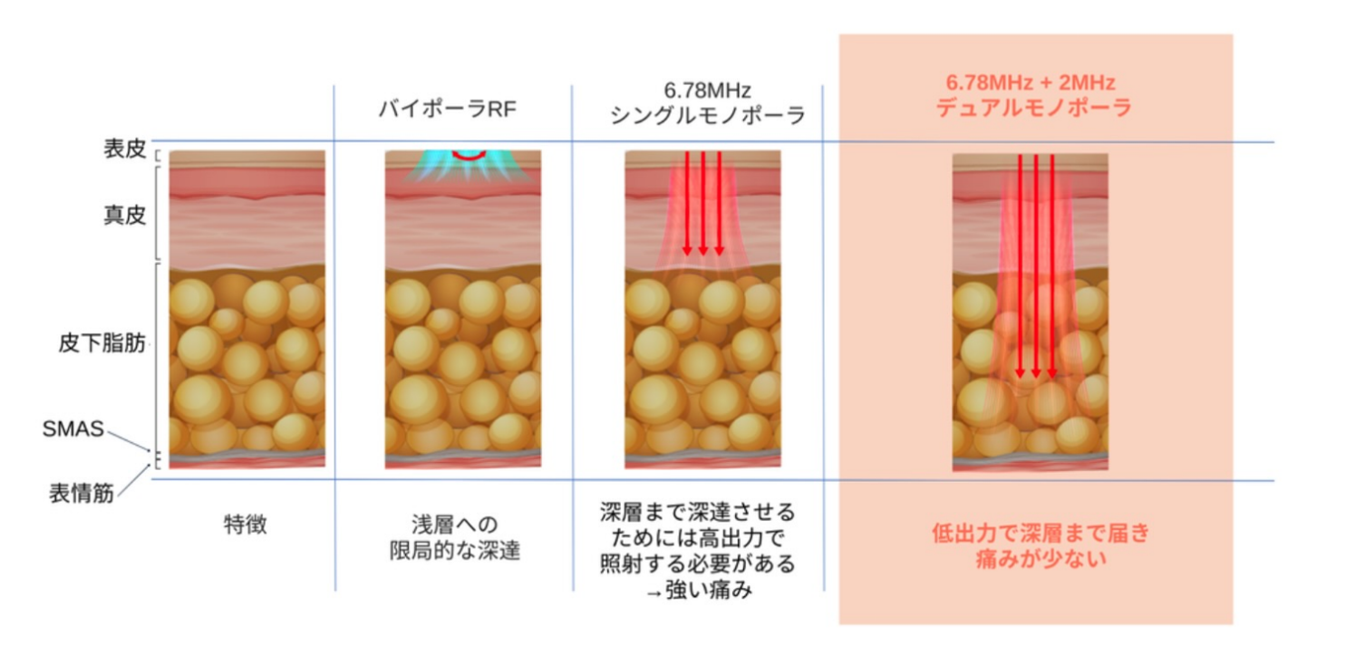 XERFとは